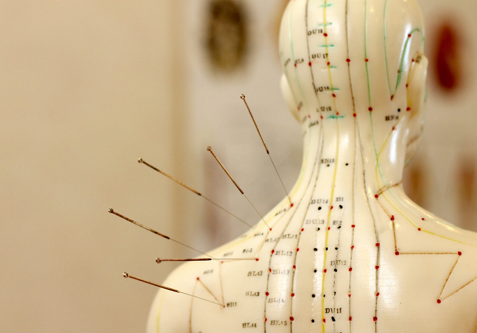 acupuncture in the therapy of pain